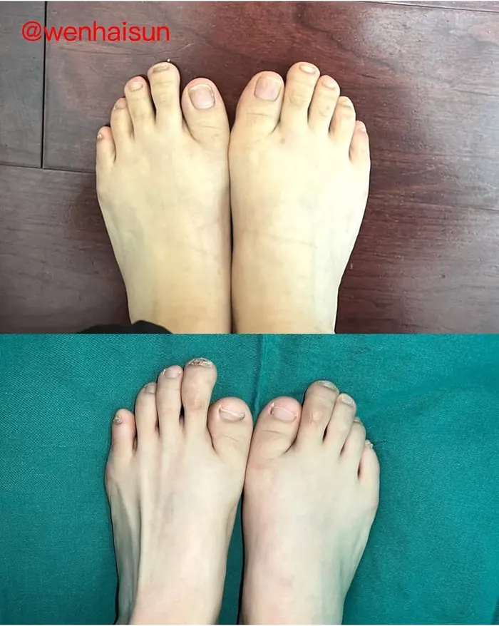 Before and after bilateral toe macrodactyly correction surgery by Dr. Sun Wenhai