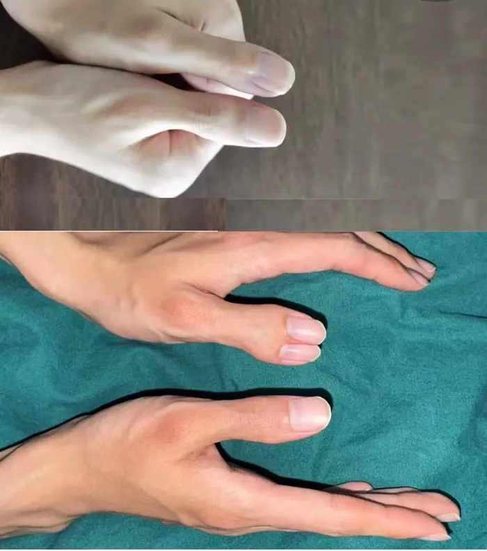 Before and after complex finger deformity reconstruction surgery by Dr. Sun Wenhai