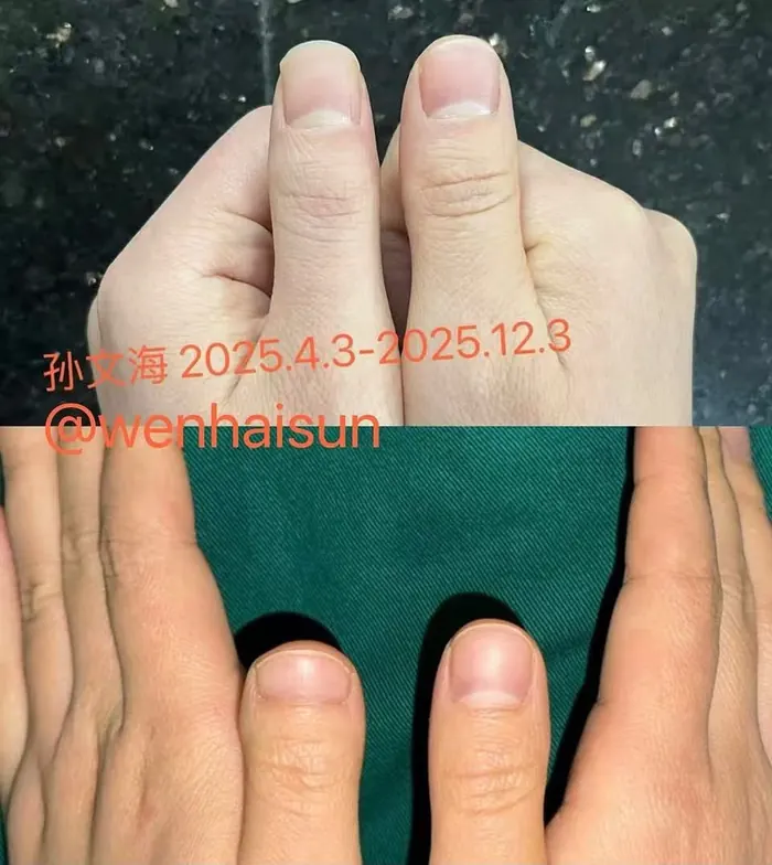 Before and after thumb deformity correction surgery by Dr. Sun Wenhai